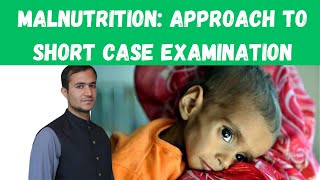 Approach to short case of Malnutrition  Malnutrition in Paediatrics Malnutrition case presentation [upl. by Sedgewinn]