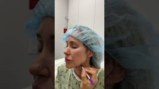 Facelift Surgery An Inside Look At Plastic Surgeons Marking Process [upl. by Ernestus122]