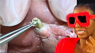 Best of Blackheads  Dilated Pore Of Winer  reaction [upl. by Coffey]