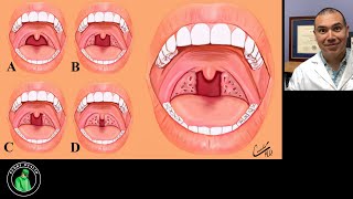 Obstructive Sleep Apnea Explained [upl. by Sirromaj]