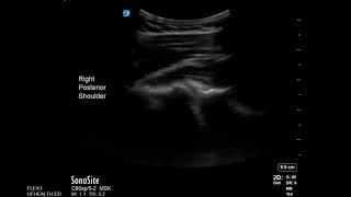 Shoulder Ultrasound Posterior Shoulder Dislocation [upl. by Yrgoerg635]