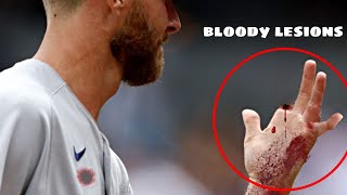 MLB• Worst And Bloodiest Injuries [upl. by Nnywg]