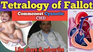 Tetralogy of Fallot  TOF  Commonest Cyanotic CHD  TET Spell  Cyanotic Spells [upl. by Nicky]