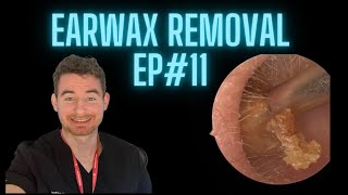 Earwax Removal Ep11  Typical Microsuction Treatment [upl. by Tera]