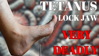 How Tetanus Can Be Very Fatal  Things to know [upl. by Eelsew72]