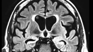 Mesial Temporal Sclerosis [upl. by Damahom]