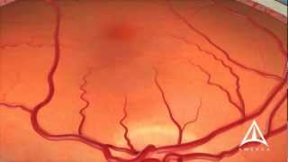 Dry Macular Degeneration [upl. by Edualc]