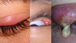 What is an Internal Stye [upl. by Aral74]