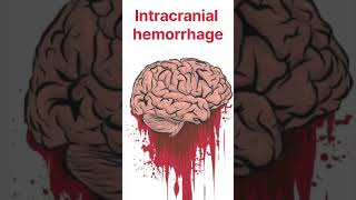 Control of Hyperpyrexia ice therapy during fever sponging during fever reason of hyperpyrexia [upl. by Avahc]