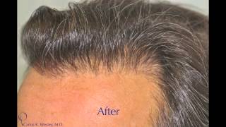 Sectioned Scalp FUE and Beard to Scalp FUE [upl. by Ayotnom]