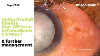 Uncontrolled Rhexis RunOff in an Intumescent Cataract and Further management with an EDOF IOL [upl. by Emelia]