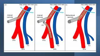 06 Cannulation by Dr Dipanjan Chatterjee ECMO INDIA OCT 2024  Day 01 [upl. by Biggs]