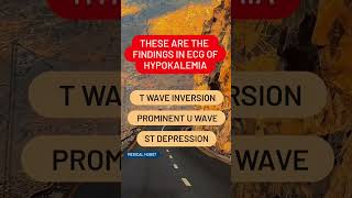 THESE ARE THE FINDINGS IN ECG OF HYPOKALEMIA [upl. by Anoel971]