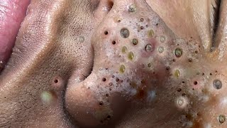 acne blackheads whiteheads removalcystic acne blackhead whitehead removalbig cystic acneext12084 [upl. by Aidile627]