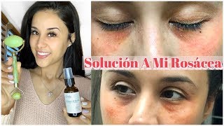 Piel Con Rosacea Y Consejos Capilares y Corporales [upl. by Malinde]