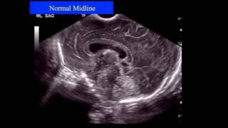 Neonatal Neurosonography The Premature Infant [upl. by Sykes]