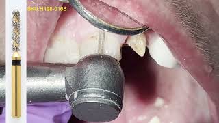 Removing And Replacing An Old Ceramic Crown [upl. by Esra]