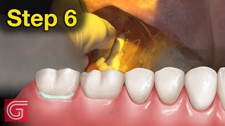 HOW TO Cement Zirconia Crown for Less Retentive Tooth Prep [upl. by Donall789]