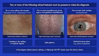 Neurofibromatosis Type 1 Clinical Diagnostic Criteria [upl. by Anirahs]