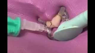 How the root canal is desinfected  Sodium Hypochlorite [upl. by Alleacim]