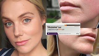 ACZONE DAPSONE GEL 5 REVIEW  Chronic Adult Acne 2 Month Progress 2021 [upl. by Lauryn]