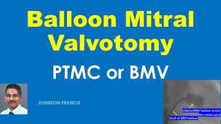 Balloon Mitral Valvotomy or Percutaneous Transmitral Commissurotomy [upl. by Nahem]