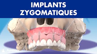 Implants ZYGOMATIQUES  Comment placer les implants sans greffe osseuse © [upl. by Etnud]