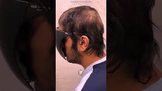 Custom Wigs for Alopecia Patients  Permanent Wigs for Alopecia  Non Surgical Hair Replacement [upl. by Sikata]