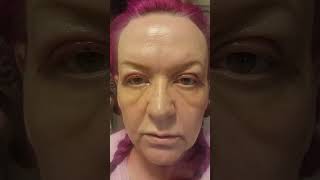 TRIGGER WARNING ⚠️ upper blepharoplasty surgery [upl. by Helfant]