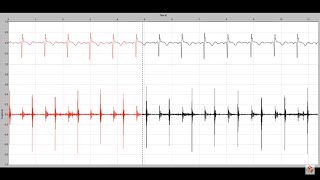 Holosystolic murmur in a child with a membranous ventricular septal defect [upl. by Shue]