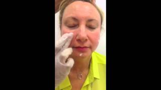 Mirvaso treatment for facial redness caused by rosacea [upl. by Etz825]