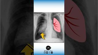 🔻 Anatomie VS Radiologie Part 2 un pneumothorax [upl. by Noby160]