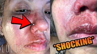 Nose Piercing Gone HORRIBLY WRONG WARNING GRAPHIC [upl. by Robert531]