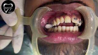 CLASS 2 DIV 1  BRACES  ORTHODONTICS  ANANTNAG trending braces dentist imrankhan [upl. by Rhett]