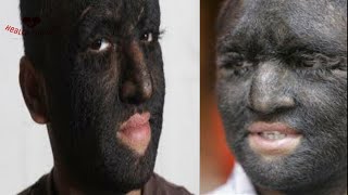 HYPERTRICHOSIS RARE but TRUE What is the Cause Find out why [upl. by Alul]