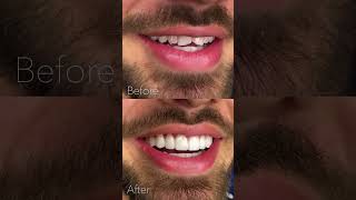 Porcelain veneer smile transformation porcelainveneers dentalrestoration dentalmakeover [upl. by Chatterjee807]