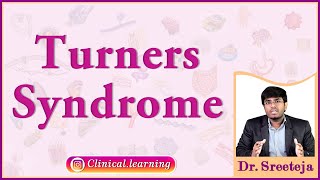 20 Turners Syndrome [upl. by Hniv]