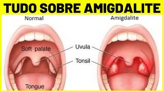 AMIGDALITE  O QUE É CAUSAS SINTOMAS E TRATAMENTO [upl. by Dleifxam453]