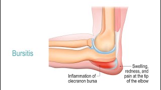 Treating Bursitis [upl. by Terzas879]