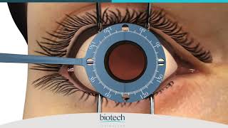 Eyecryl TORIC Range Axis Marking amp Implantation Guide [upl. by Raybin]