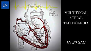 Multifocal Atrial Tachycardia Animation and ECG Shorts [upl. by Ahrendt]