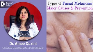 Know what Causes FACIAL MELANOSIS Types Symptoms and Treatment  Dr Amee Daxini  Doctors Circle [upl. by Selrahc]