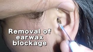 Dry Earwax Blockage Removal [upl. by Bijan]