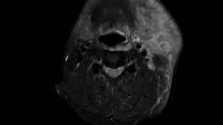 Masticator space abscess A Ahuja AT et al 2017 Book Essential Radiology [upl. by Aldarcy545]