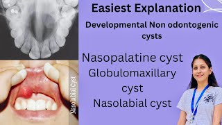 Developmental Non Odontogenic cysts Oral Pathology BDS Nasopalatine Globulomaxillary Nasolabial [upl. by Arenat]