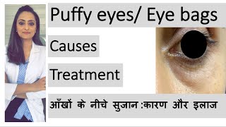 puffy eyes eye bags aankhon ke neeche sujan  कारण और इलाज  Dr Aanchal  dermatologist [upl. by Ania69]