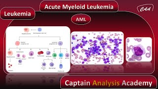 E3 Acute Myeloid Leukemia AML سرطان الدم الميلودى الحاد [upl. by Lotta695]