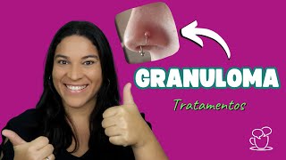 Granuloma PÓS PIERCING o que é e como tratar [upl. by Yedok]