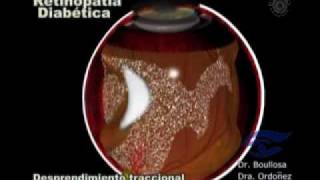 Desprendimiento de retina en diabetes [upl. by Nywrad358]