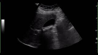 Gallbladder ultrasound [upl. by Imuya]